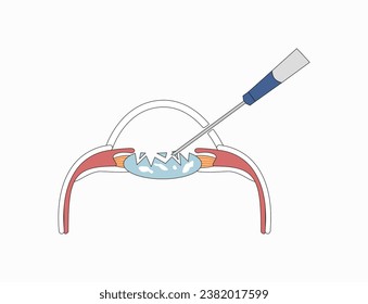 Eye laser surgery, ophthalmology lasik treatment icon, vector vision medical correction. Eye laser surgery for cornea disease or myopia operation on retina, refractive eyesight correction.