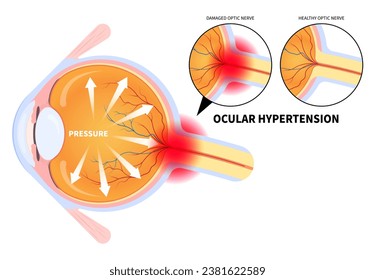 Eye pain anatomy with blurry vision and Ocular hypertension the examination for optic nerve cancer injury bleeding