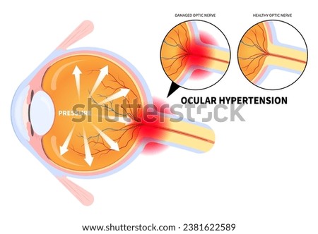 Eye pain anatomy with blurry vision and Ocular hypertension the examination for optic nerve cancer injury bleeding Foto d'archivio © 