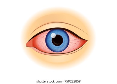Eye redness symptom of human isolated on white. Illustration about health problem.