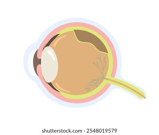 Olho com ilustração do vetor de descolamento da retina. Retina descolada após lesão traumática