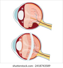 eye retinal problems vector form