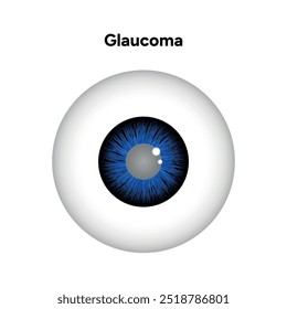 Defeito da estrutura ocular do olho Glaucoma