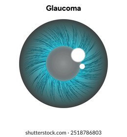 Defeito da estrutura ocular do olho Glaucoma