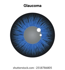 Defeito da estrutura ocular do olho Glaucoma