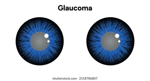 Defeito da estrutura ocular do olho Glaucoma