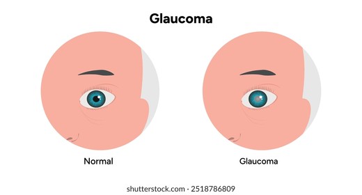 Defeito da estrutura ocular do olho Glaucoma