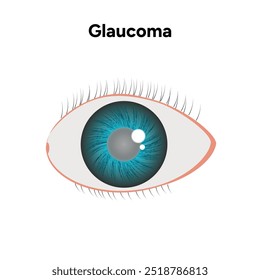 Defeito da estrutura ocular do olho Glaucoma