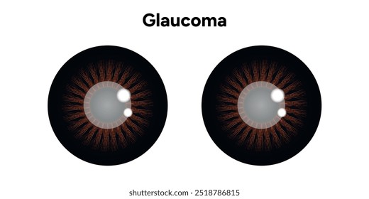 Defeito da estrutura ocular do olho Glaucoma