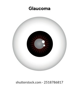 Defeito da estrutura ocular do olho Glaucoma