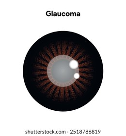 Defeito da estrutura ocular do olho Glaucoma