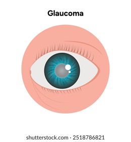 Defeito da estrutura ocular do olho Glaucoma