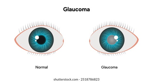 Defeito da estrutura ocular do olho Glaucoma