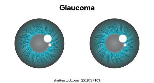 Defeito da estrutura ocular do olho Glaucoma