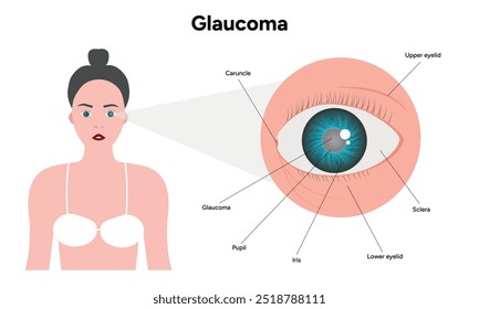 Defeito da estrutura ocular do olho Anatomia do glaucoma