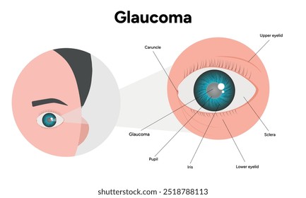 Defeito da estrutura ocular do olho Anatomia do glaucoma