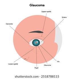 Defeito da estrutura ocular do olho Anatomia do glaucoma