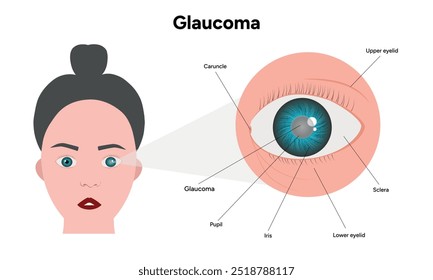 Defeito da estrutura ocular do olho Anatomia do glaucoma