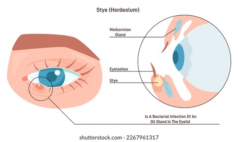 Ojos o cuerdas. Rojo, doloroso bulto cerca del borde del párpado. Infección bacteriana de la glándula ósea. Cartel de educación oftalmológica. Ilustración vectorial plana