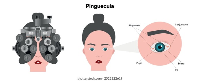 Exames oculares. Manchas amarelas pinguéculas no olho. Problema oftalmológico