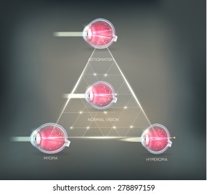 Eye vision disorders triangle background. Normal eye, Astigmatism, hyperopia and myopia.