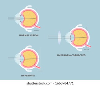 eyeball anatomy, internal organs body part nervous system, eyesight, longsighted, farsighted, hyperopia corrected concept, vector illustration cartoon flat design clip art