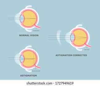 restaurează viziunea cu astigmatism