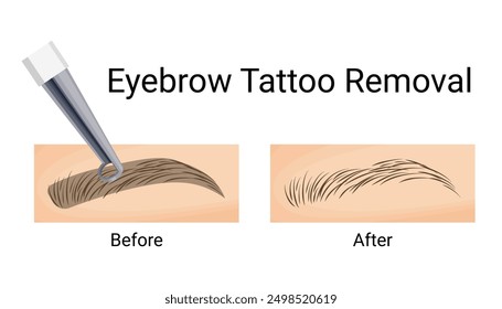 Eyebrow Tattoo Removal, Before and After Results, Vector Illustration