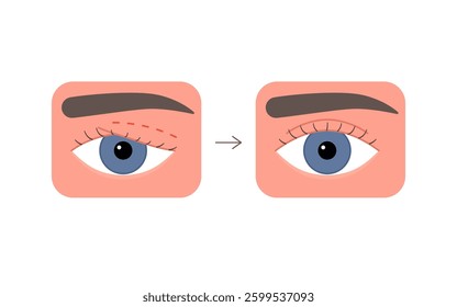 Eyelid correction, blepharoplasty. Before and after aesthetic plastic surgery of eye. Lift eyelid. Surgical facial rejuvenation. Vector illustration