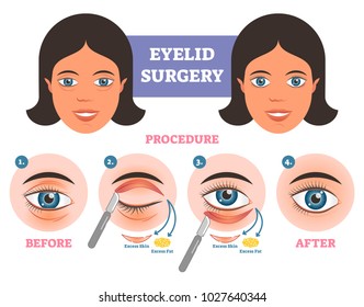 Eyelid surgery procedure before  after illuatration with main steps. Excess skin and fat removal plastic surgery. 