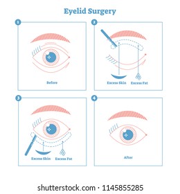 Eyelid surgery procedure scheme illustration with main steps. Excess skin and fat removal plastic surgery. Women fashion and beauty informative material with beautiful line style graphic design.