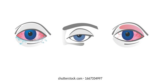 Eyes disease vector icons. Redness and tired. Medical ophthalmology set. 