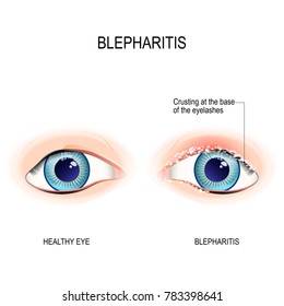 Eyes of human. Blepharitis. Crusting at the eyelid margins (base of the eyelashes) due to excessive bacterial buildup along the lid margins. Human anatomy. Vector diagram for educational, and medical 