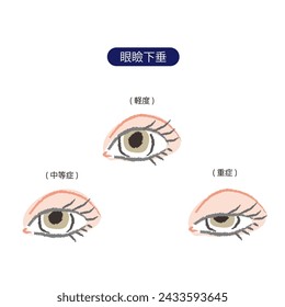 Ojos con ptosis en tres etapas: leve, moderada y grave.
"GANKENKASUI" significa ptosis, "KEIDO" significa leve, "CHUTOSHO" significa moderado, "JUSHO" significa severo.