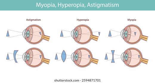 Eyesight disorders. Normal eye, Astigmatism, hyperopia and myopi