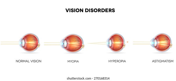 Eyesight Disorders. Normal Eye, Astigmatism, Hyperopia And Myopia.