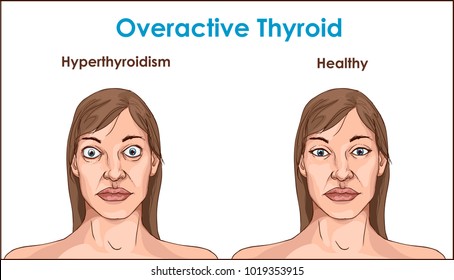 hyperthyroidism face