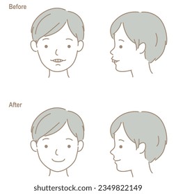 The face of a child with buck teeth, before and after orthodontic treatment