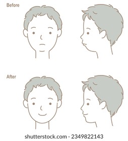 The face of a child with a small jaw and teeth, before and after orthodontic treatment