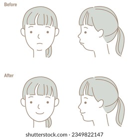 The face of a child with a small jaw and teeth, before and after orthodontic treatment