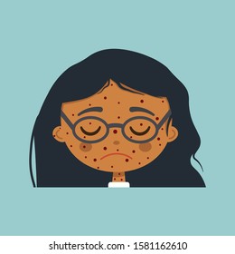 Face of a dark-skinned boy with rash, baby pimples, girl with chickenpox, vector, flat illustration