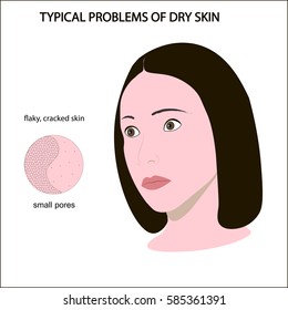 Face of girl with dry skin: small pores, cracked skin