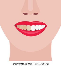 Face girl. Smile with dirty and clean teeth. Vector illustration