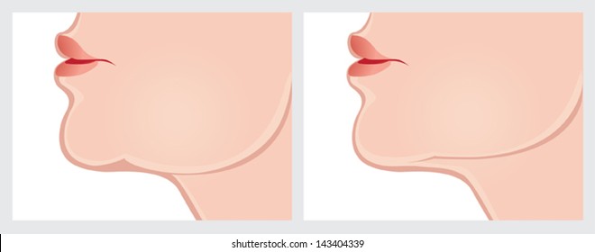 Face lift before and after treatment. Vector image on the white background easy to add.
