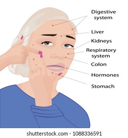 Face Mapping. What Your Acne Telling You Info-graphic