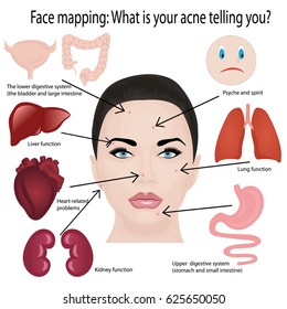 Face Mapping. What Your Acne Telling You Info-graphic