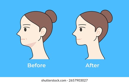 Face Neck Lift vor und nach