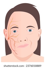 Face nerve injury central motor neuron infectious or ptosis of bell's cranial hyperacusis in the hemiplegia nystagmus and chicken pox skin simplex otalgia tinnitus multiple sclerosis