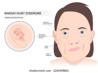 Face ptosis of bell's cranial central motor neuron Infectious chicken pox skin hemiplegia hyperacusis nystagmus simplex otalgia tinnitus multiple sclerosis