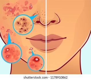 Face with skin problems. Before, after.  Vector illustration